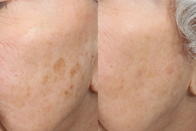 Customer skin before and after