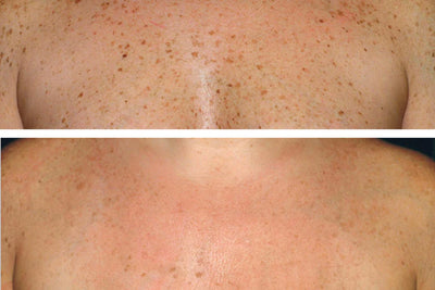 Customer body skin before and after